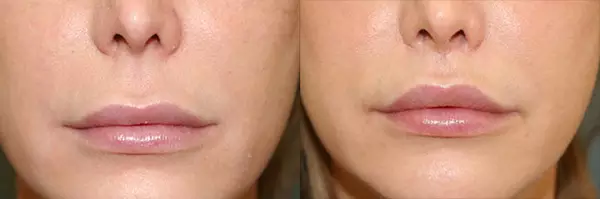 lip-lift-resultat-avant-apres