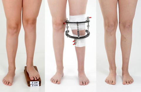 Leg lengthening Before - After