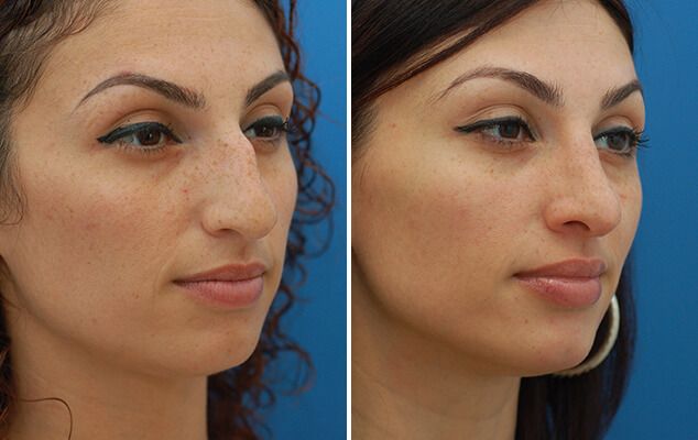 rhinoplastie-nez-bossu-istanbul-Turquie